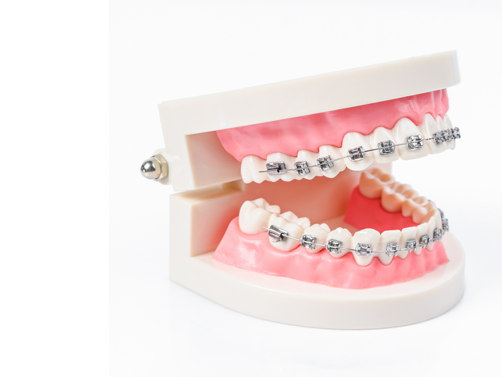 image of metal braces