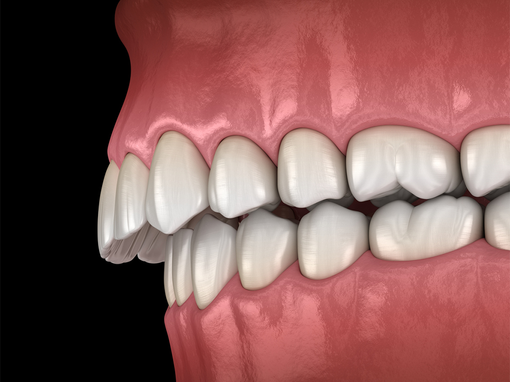 graphic of an overbite