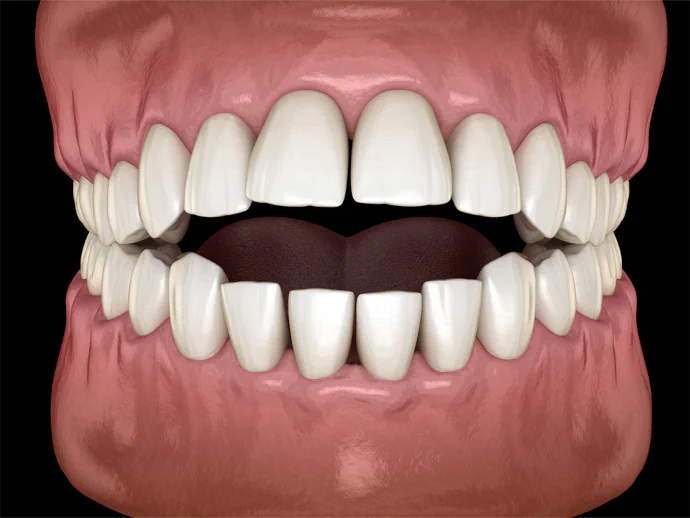 Open Bite Correction in Victor, New York at Victor Smiles