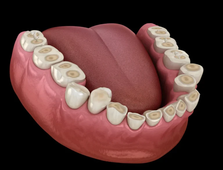 Teeth grinding prevention in Victor, New York at Victor Smiles