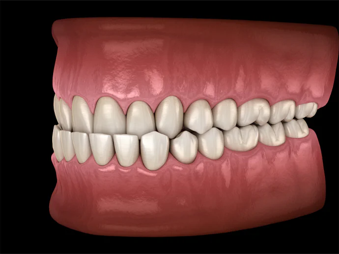 Underbite treatment in Victor, New York at Victor Smiles